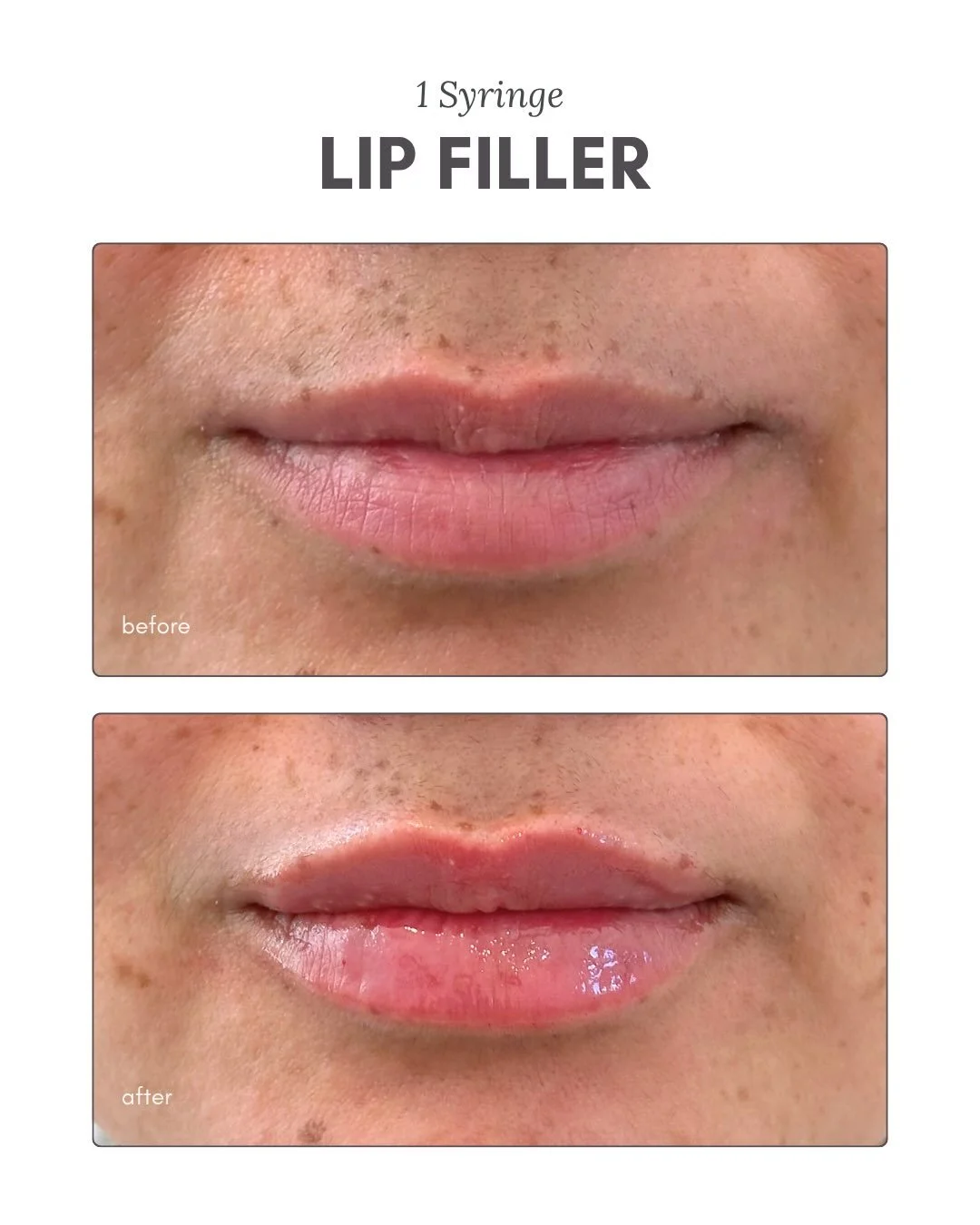 Trick or treat yourself to a little extra volume👻💉💋

Injector: @ali_keila_ 

Booking link below or call 845-420-4014

#lipfiller #filler #hudsonvalley #dutchesscounty #lipfillerbeforeandafter