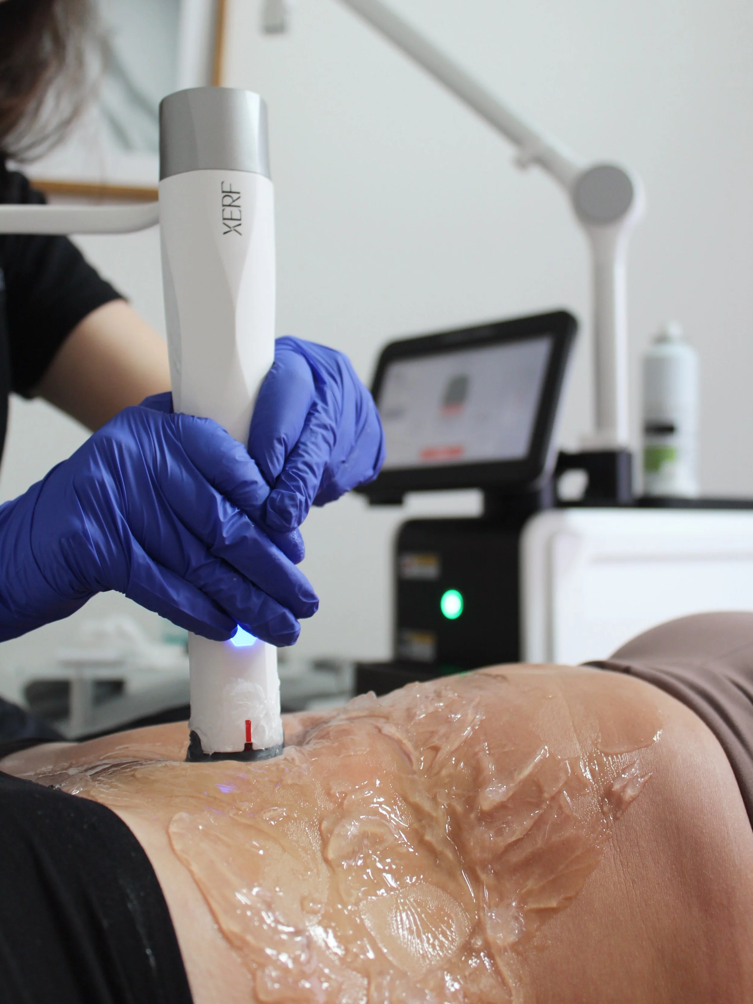 Let&rsquo;s talk about the skin your workouts can&rsquo;t tighten!! 📣

Because sometimes, it&rsquo;s not about how many hours you spend in the gym. It&rsquo;s about collagen, elasticity, and what happens to our skin over time.

Enter XERF. 🔥

This 