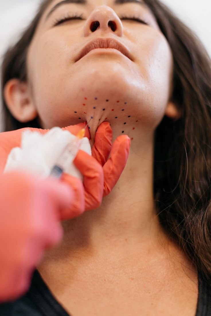 Medical professional performing a dermatological procedure on a woman's chin, with marked dots indicating treatment points.