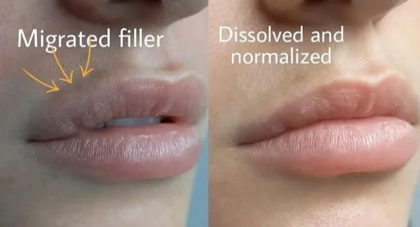 Comparison of lips showing migrated filler on the left and dissolved and normalized lips on the right.