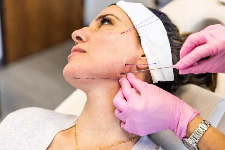 Woman undergoing a cosmetic procedure on her jawline, with markings and a surgical tool, while lying down with a cloth on her forehead.