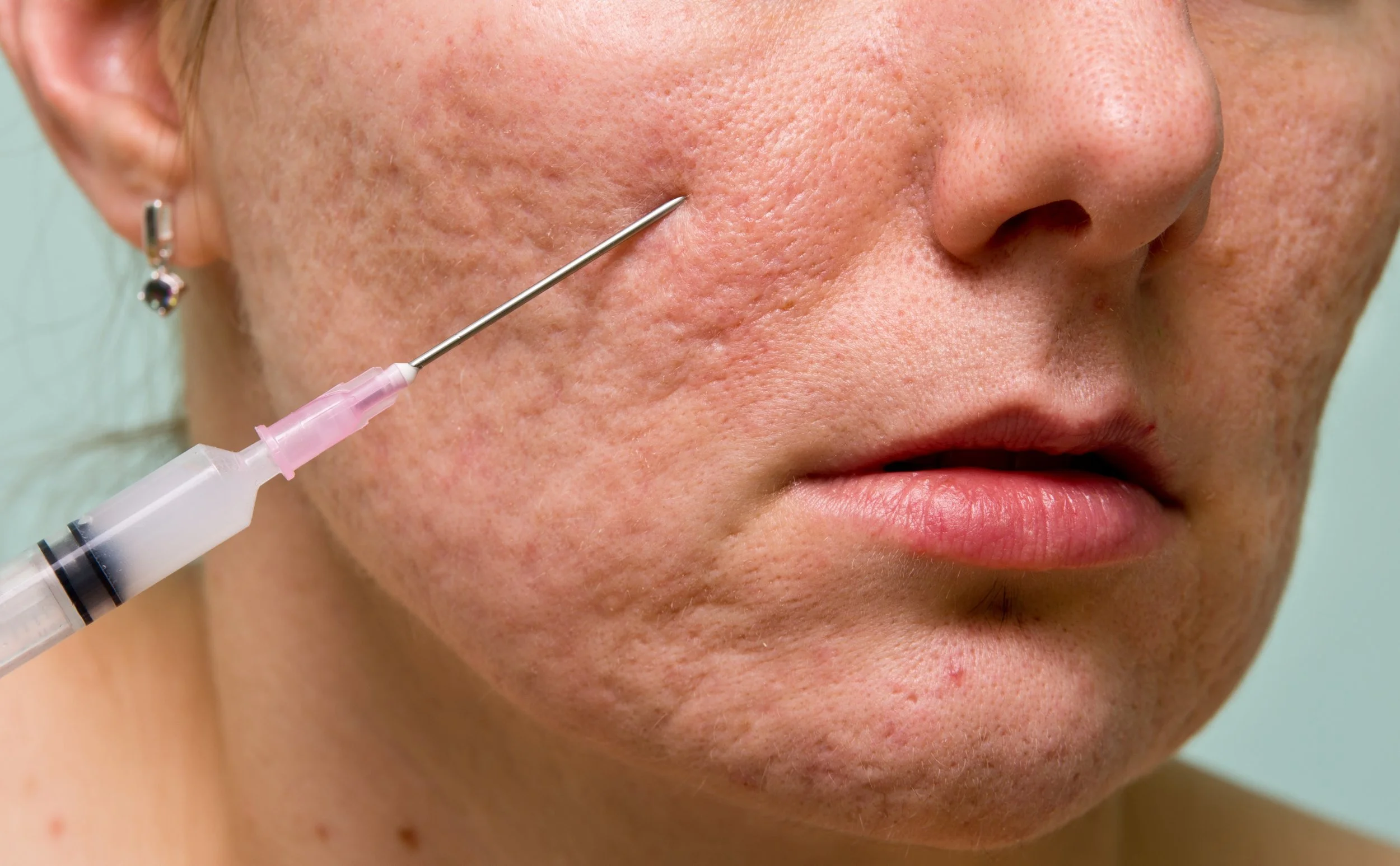 Close-up of a person's cheek with acne scars being treated with a syringe and needle.