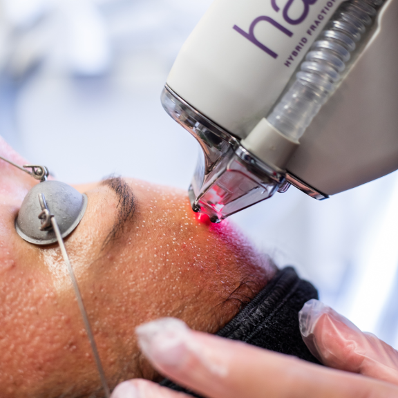 A person receiving laser skin treatment on their face with a specialized device emitting a red laser beam.
