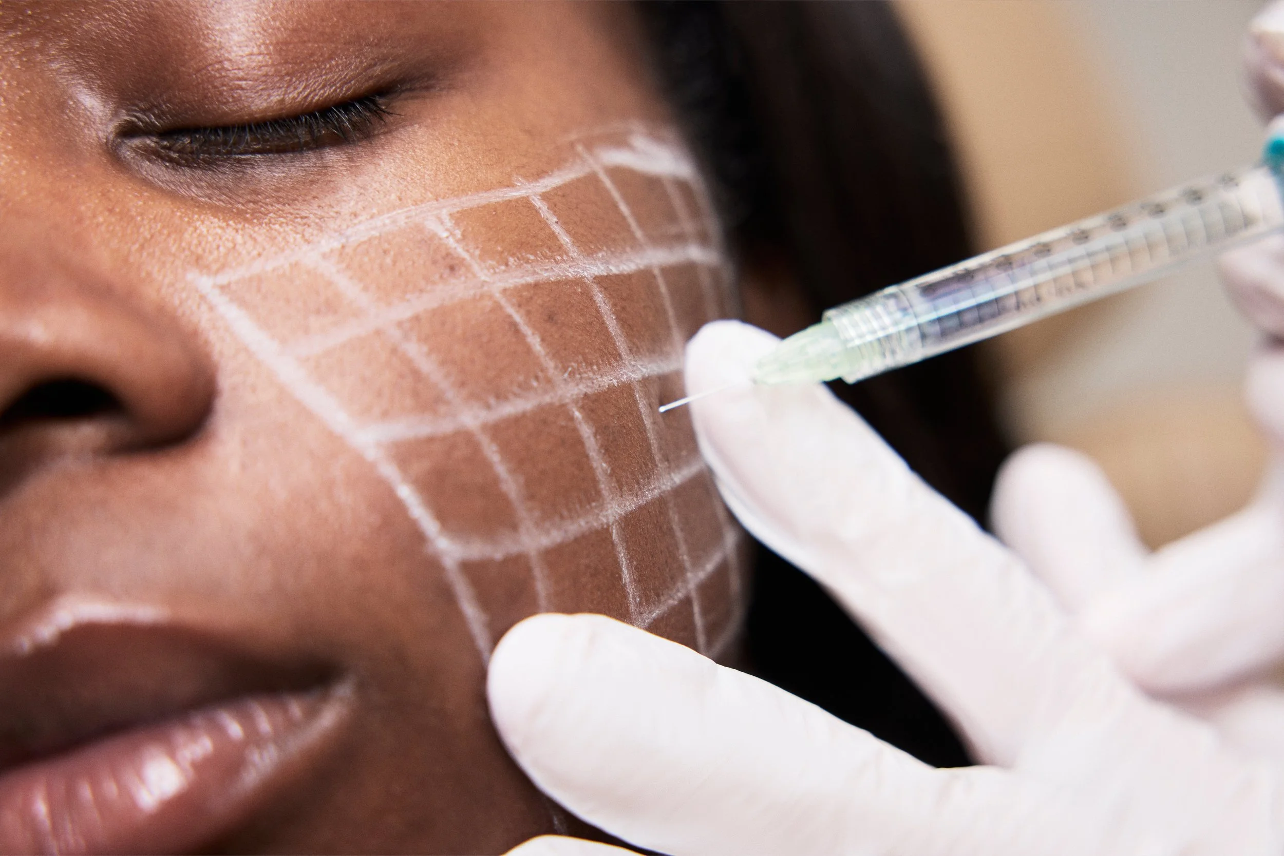 A person with dark skin receiving a cosmetic or medical injection on their face, with grid markings drawn on the cheek for guidance, as a gloved hand administers the injection with a syringe.