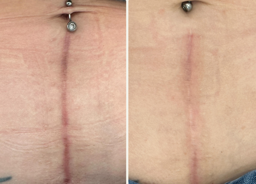 Close-up of a vertical scar on skin, with one side showing scar tissue and the other showing healing skin.