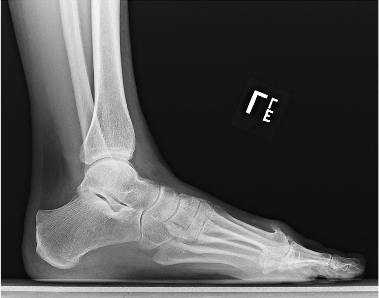 Bone Spurs In Knee: Causes, Symptoms & Treatment Of Knee Osteophytosis