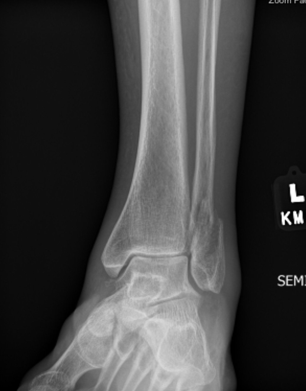 Ankle fracture — Tonya An, MD