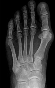 Before surgery X-ray