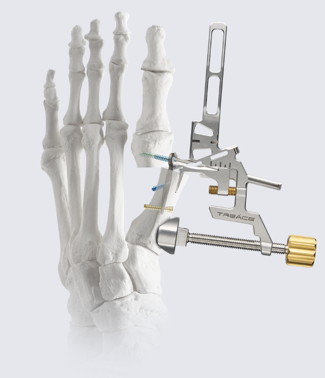 Treace Medical Nanoplasty