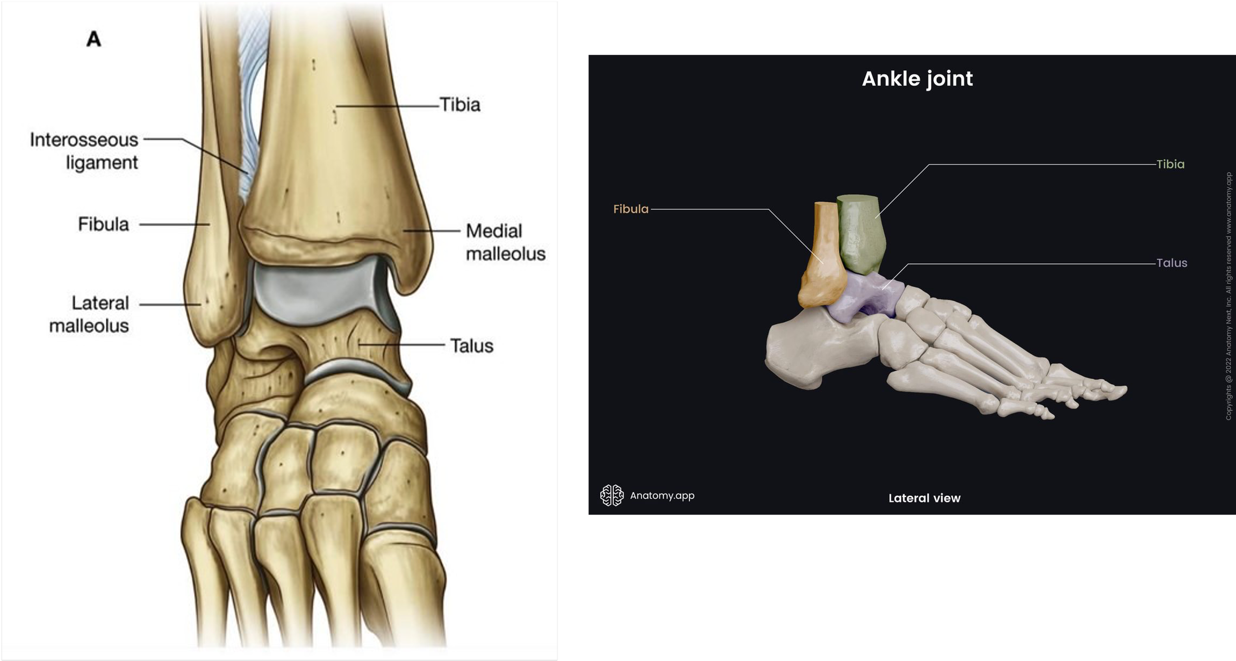 Ankle fracture — Tonya An, MD