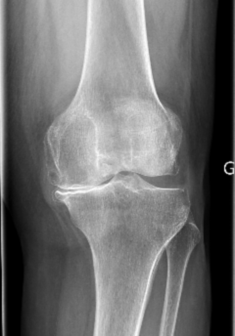 Radiographie de genou arthrosique — consultation chirurgien orthopédiste Toulon Var