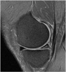 IRM du genou — lésion méniscale dégénérative — Dr Guilhem, chirurgien orthopédiste à Toulon