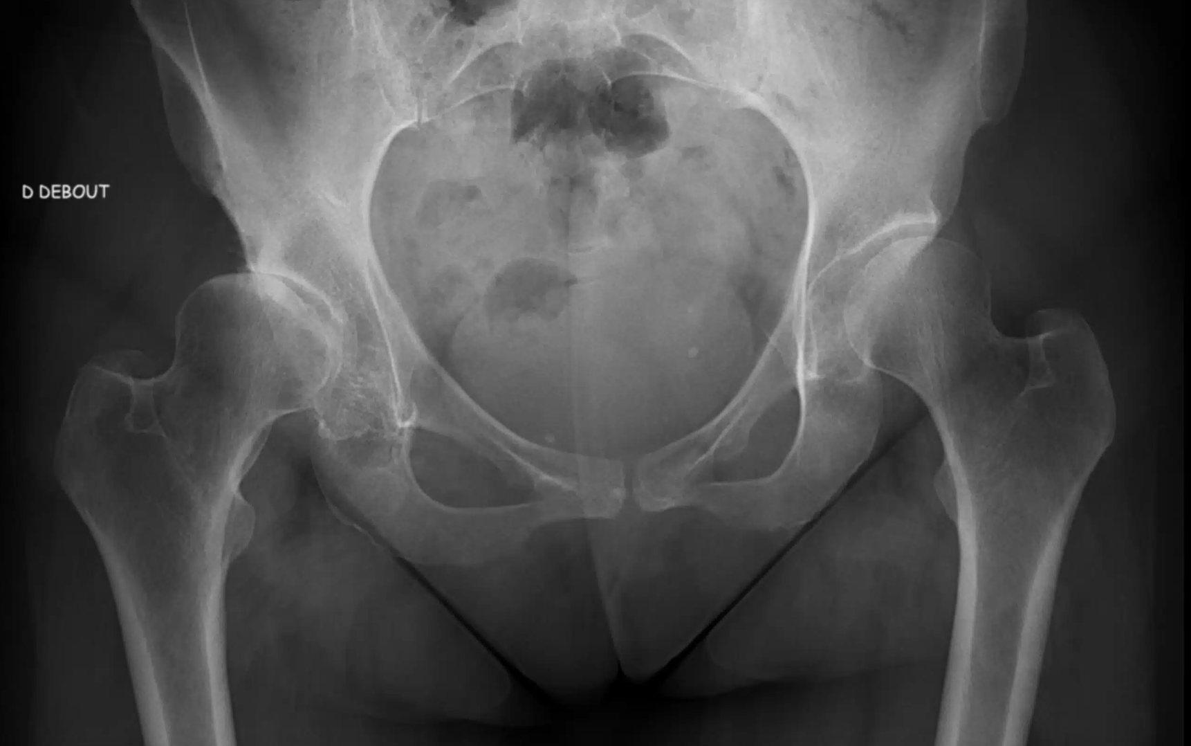 Dysplasie de la hanche chez l'adulte à Toulon : opérer ou pas ? | Dr Guilhem
