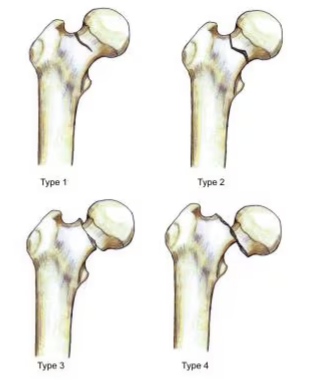 fractures-du-col-du-f-mur-diagnostic-classification-et-traitements