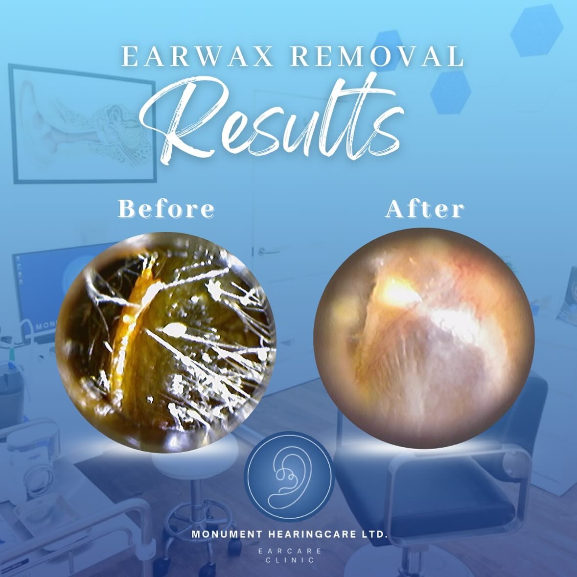 Before &amp; After treatment 👂🏼✅ SWIPE to see the end result!!😱🤯 

Struggling with blocked ears? Get in touch to book your appointment for clearer hearing today! 📲 www.monumenthearingcare.co.uk 

#earwaxremovalresults