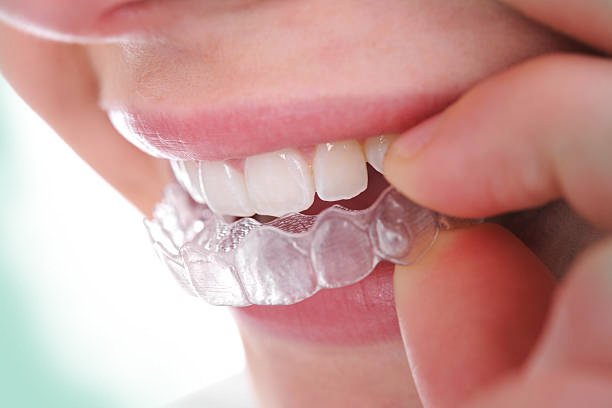 Invisible Braces in Manhattan, NY — The Dental Boutique
