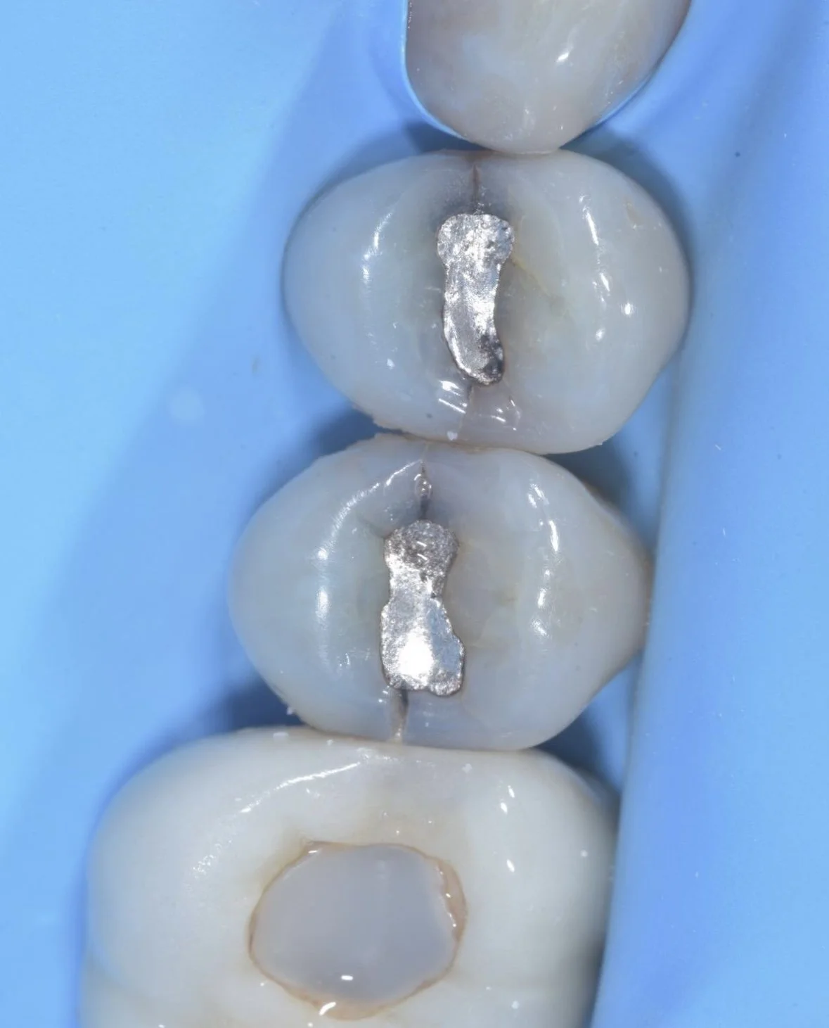 1-2-3-4 Risk Assessment: How We Biomimetically Assess Your Teeth