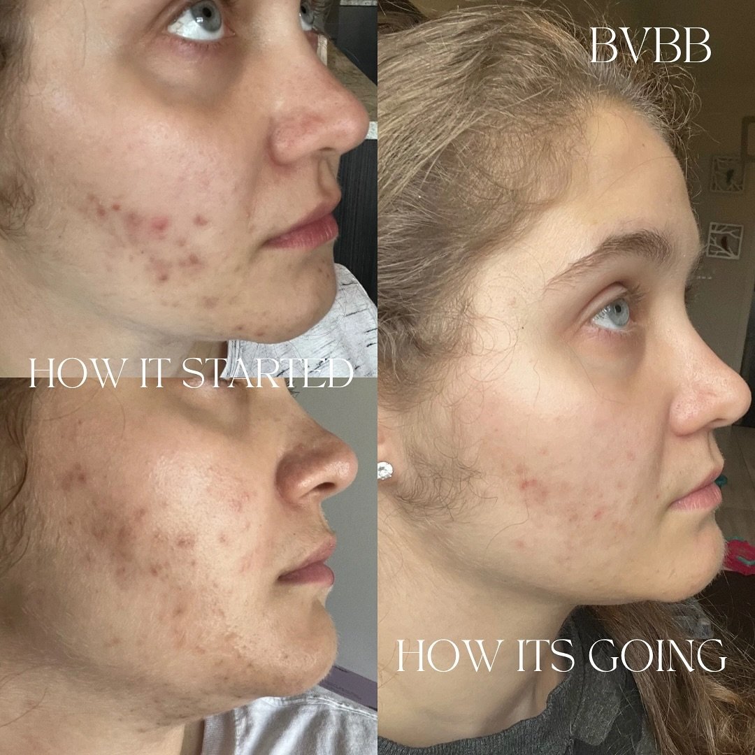 6 months working with this beauty🫧🪄

We have come so far, I am beyond grateful for your trust &amp; commitment!!!🫶

It takes two to see results🤞&hellip;.

An esthetician who will educate you, guide you, &amp; support you!!!

A dedicated client wh
