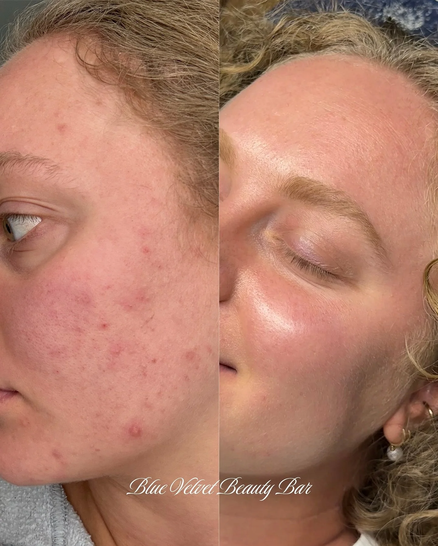 One year of customized skincare🫧✨ 

Curated by me using @glymedpluscanada @hydrinity_canada  @colorescience 

Her skin is absolutely glowing🪩 

Now accepting new clients, book a consultation through the 🔗 in my bio💌
