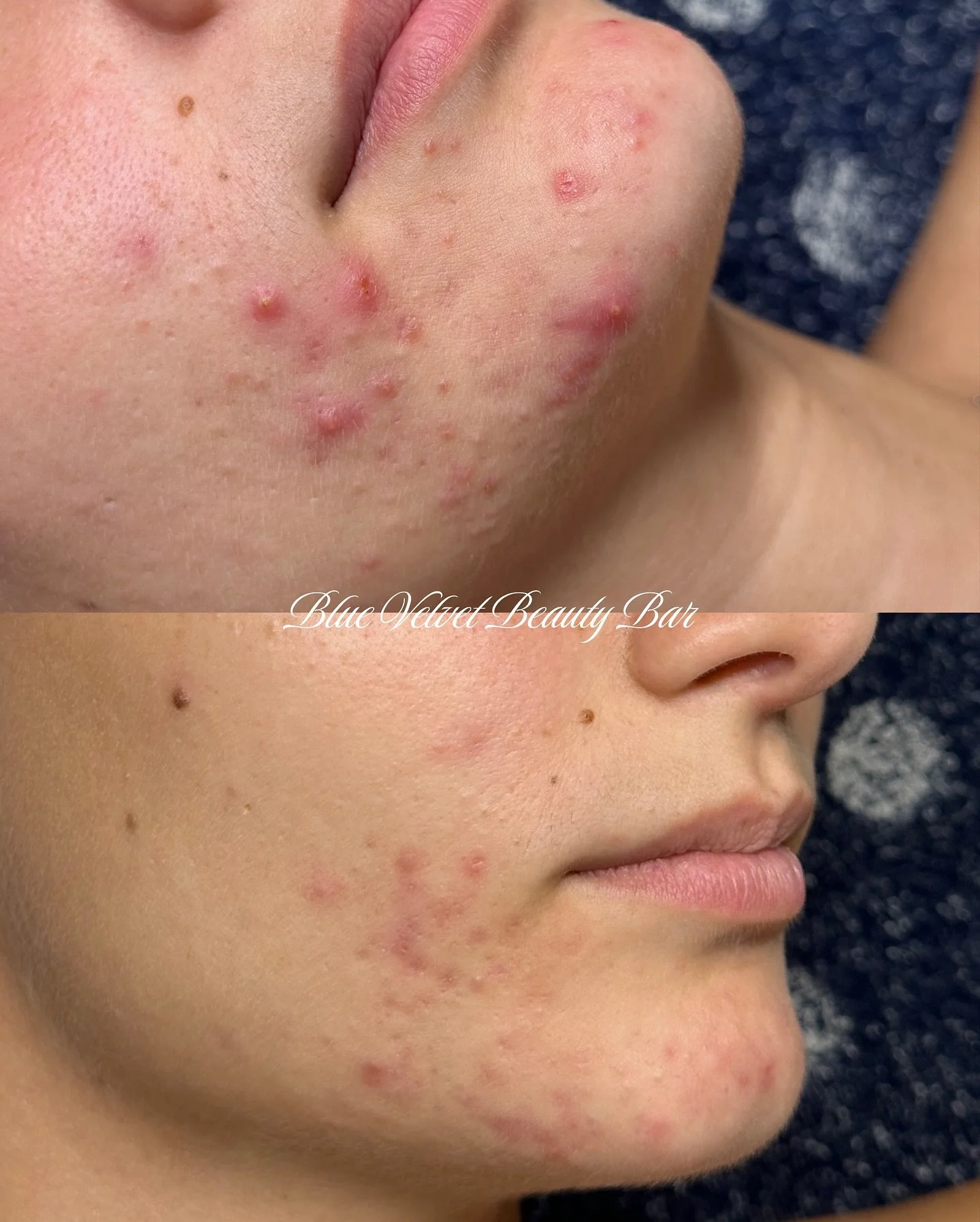 So beyond happy for this beauty ✨
She&rsquo;s been an absolute dream client🥹 fully committed to her skin journey and never gave up, even during the purging phase!🩵

These results were achieved through a customized skincare routine curated by me usi