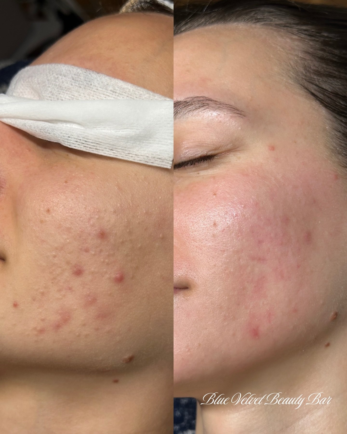 ✨ One month apart ✨
Before her 1st treatment vs. after her 2nd.

We&rsquo;re targeting congestion and keeping her skin clear. Non-inflammatory acne can be one of the trickiest types to treat, which is why consistency is key.

Her plan includes a cust
