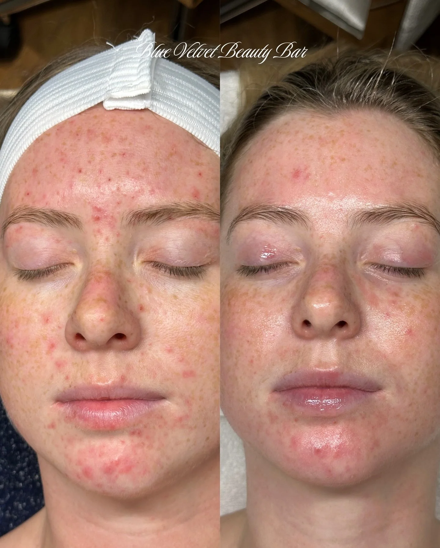 Progress✨🫧

We&rsquo;ve been working together for 9 weeks, and we are not done yet!

When we first started, she shared that her skin was super sensitive and reacted to everything. She was hesitant at first, but I&rsquo;m so grateful for the trust sh