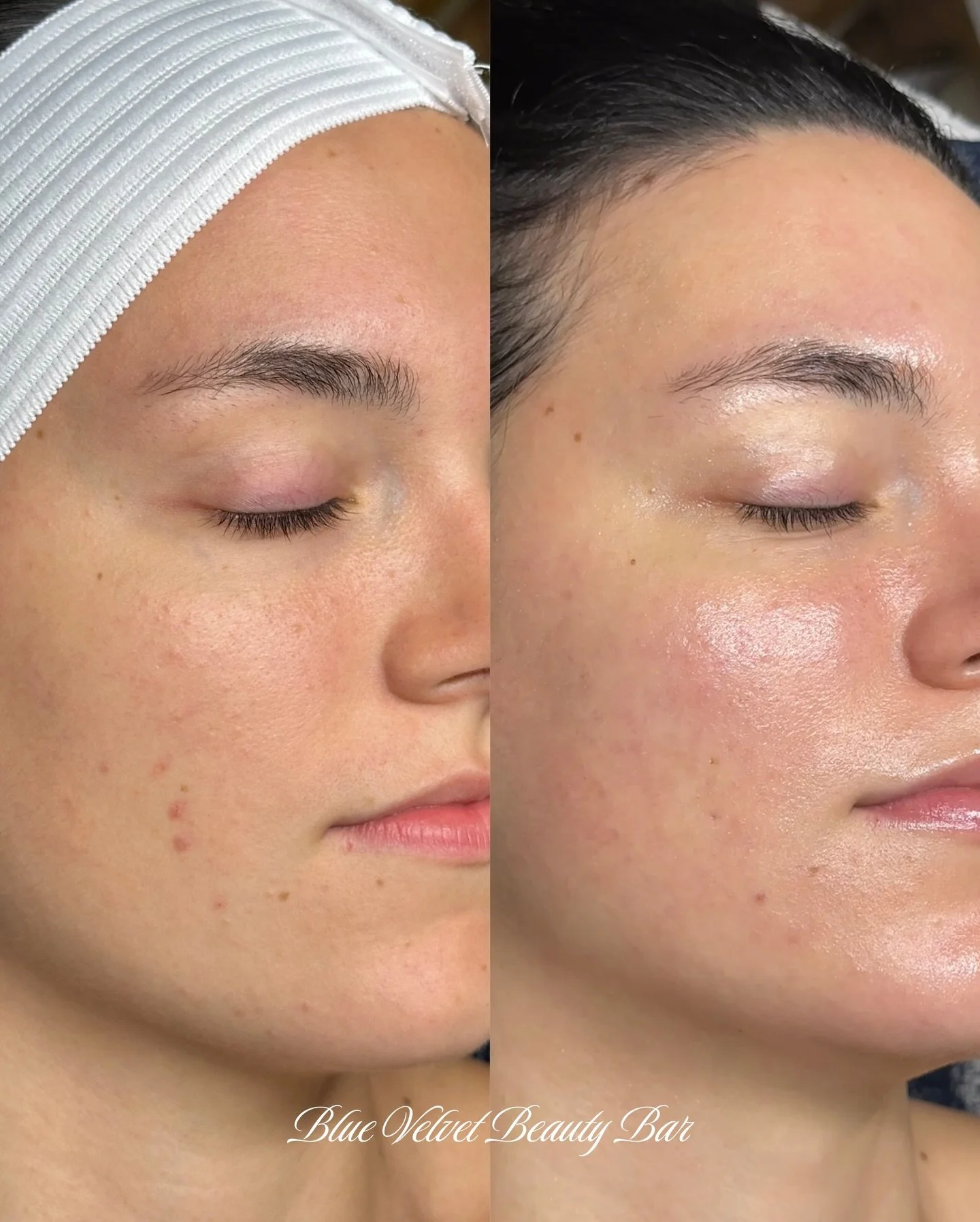 10 weeks working with this beauty ✨
A simple, consistent routine using @glymedpluscanada that she could stay committed to, paired with monthly facials and custom peels.

If you&rsquo;re ready to work together, book a consultation (link in bio) or mes