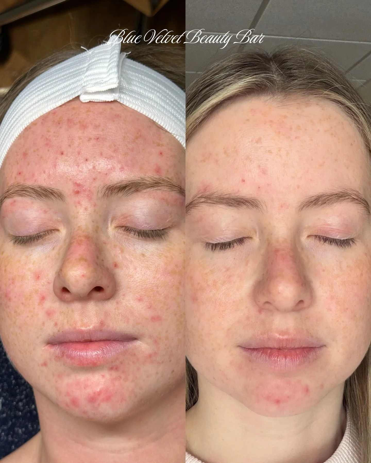 We&rsquo;re officially at 3 months working together and the progress continues🤍

When we first started, she shared that her skin was extremely sensitive and reacted to everything. We focused on strengthening her barrier, and built tolerance. 

So fa