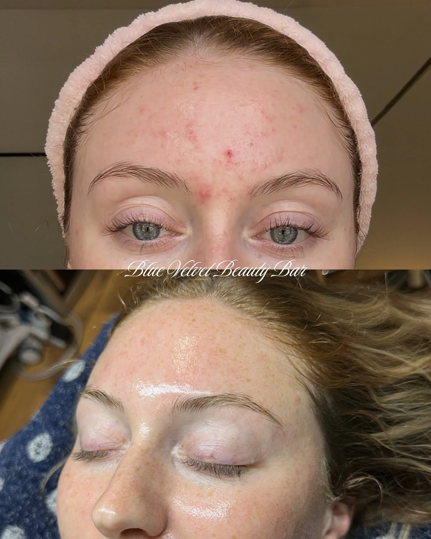 Forever one of my favourite skin transformations 🤍 I had to repost.

This was 5 months of working together virtually, followed by her first in person treatment✨

We focused on a fully customized routine tailored to her specific skin concerns, provin