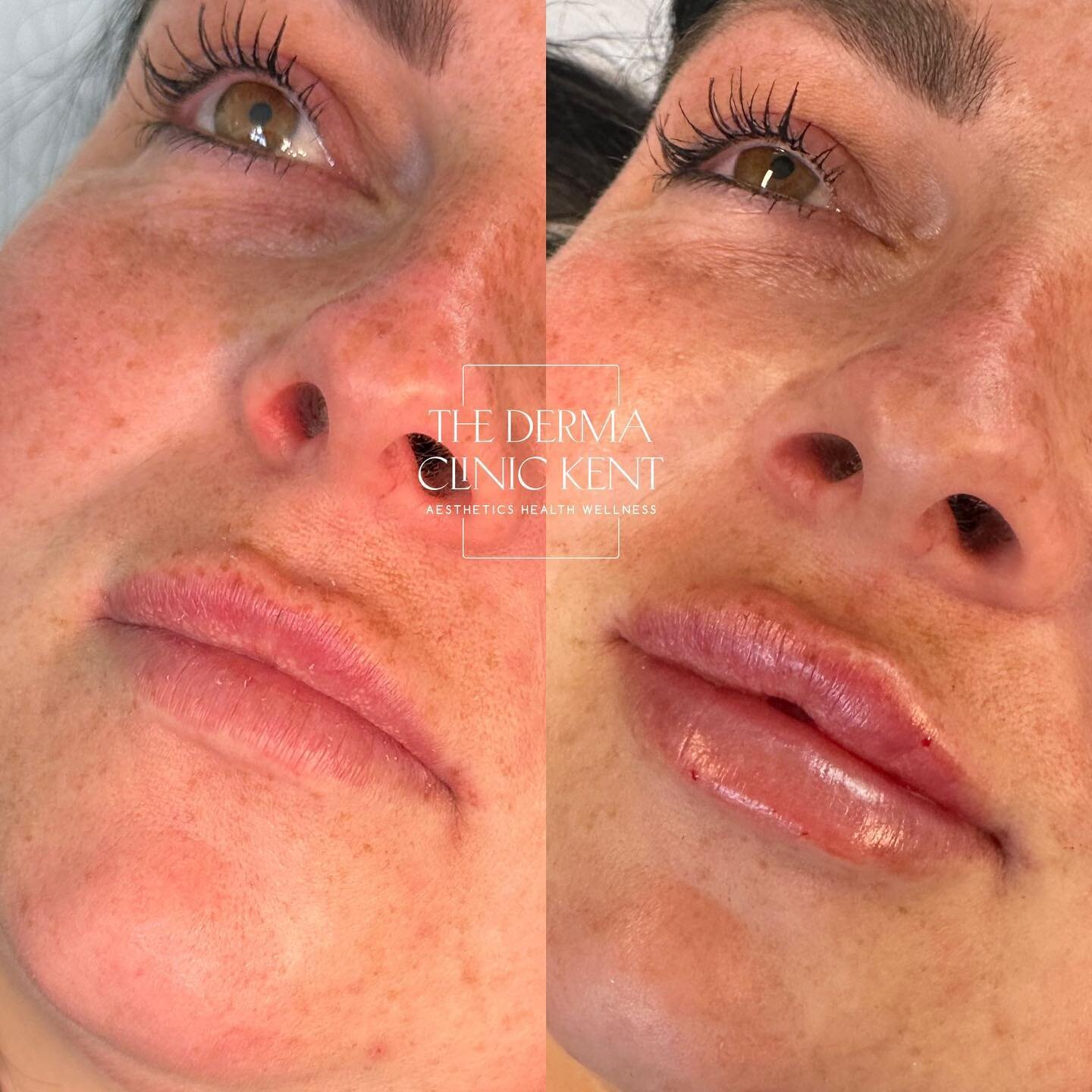 Gorgeous little pre birthday lip tweak for this absolute babe! Happy birthday 🥳 @lucyshrubsole 

We used 0.7ml to give a little va va voom to the cupids bow giving this cute little keyhole pout 💋