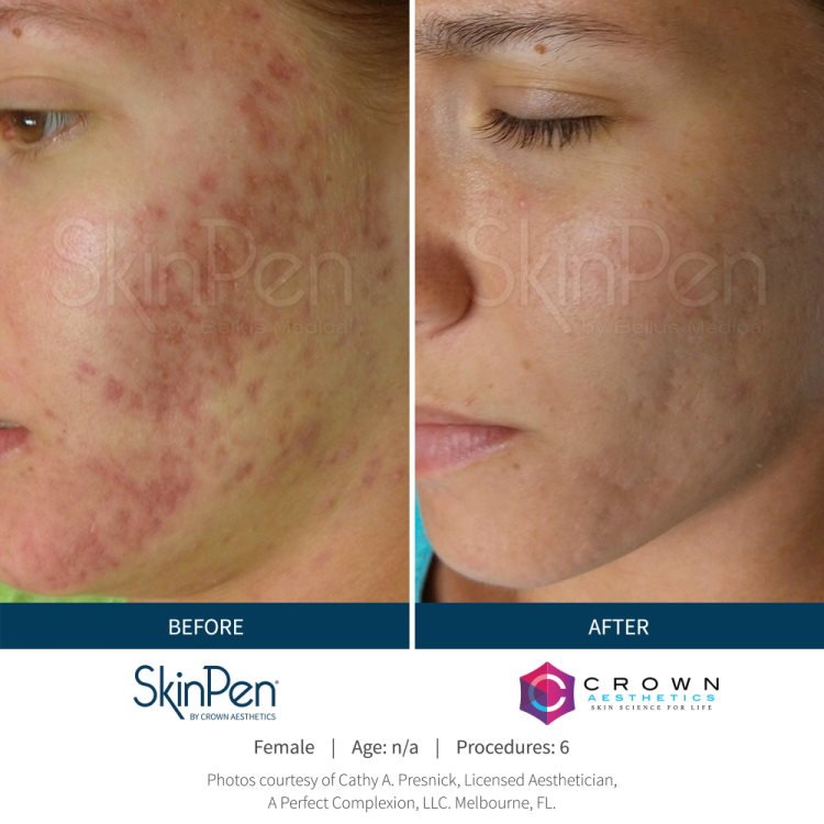 Unlocking the Benefits of SkinPen Microneedling for Radiant Skin: