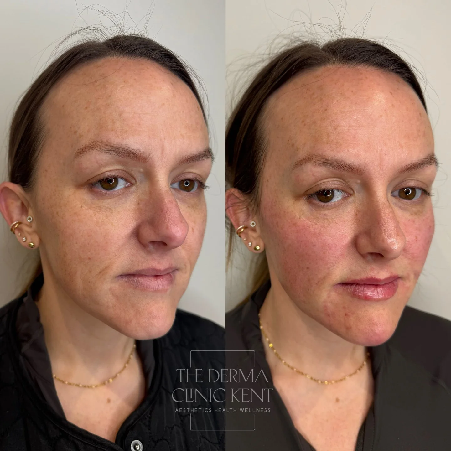 Balance, harmony, definition ✨

This gorgeous transformation was all about restoring structure and subtly enhancing features, while keeping everything looking completely natural.

By working on the cheeks, chin, jawline and lips together, we created 