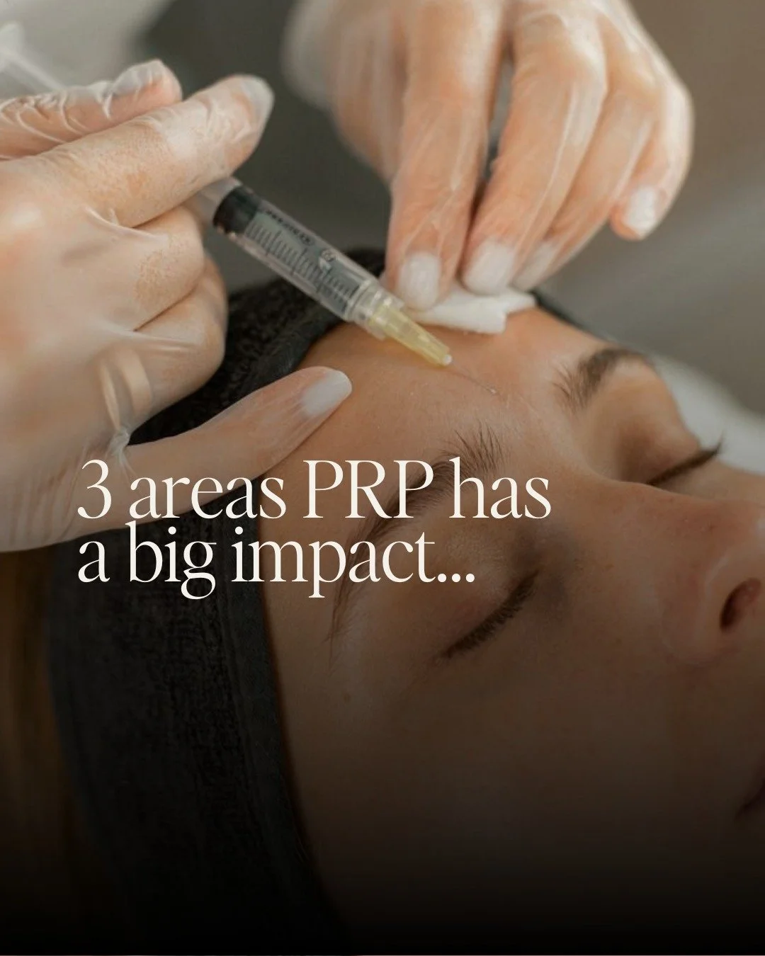 You&rsquo;ve probably heard of PRP, often called the &ldquo;vampire facial&rdquo;, but what it actually does goes far beyond the hype.

By using the healing power of your own blood, PRP stimulates collagen, boosts circulation and repairs tissue at a 