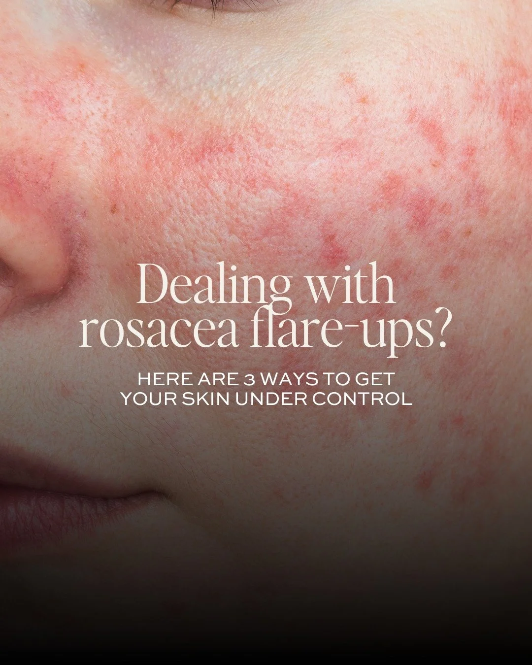 Struggling with redness, flushing or sensitivity that seems to flare up out of nowhere?

Rosacea can feel unpredictable and frustrating, especially when the products that promise to &ldquo;fix&rdquo; it often end up making things worse.

The key is c