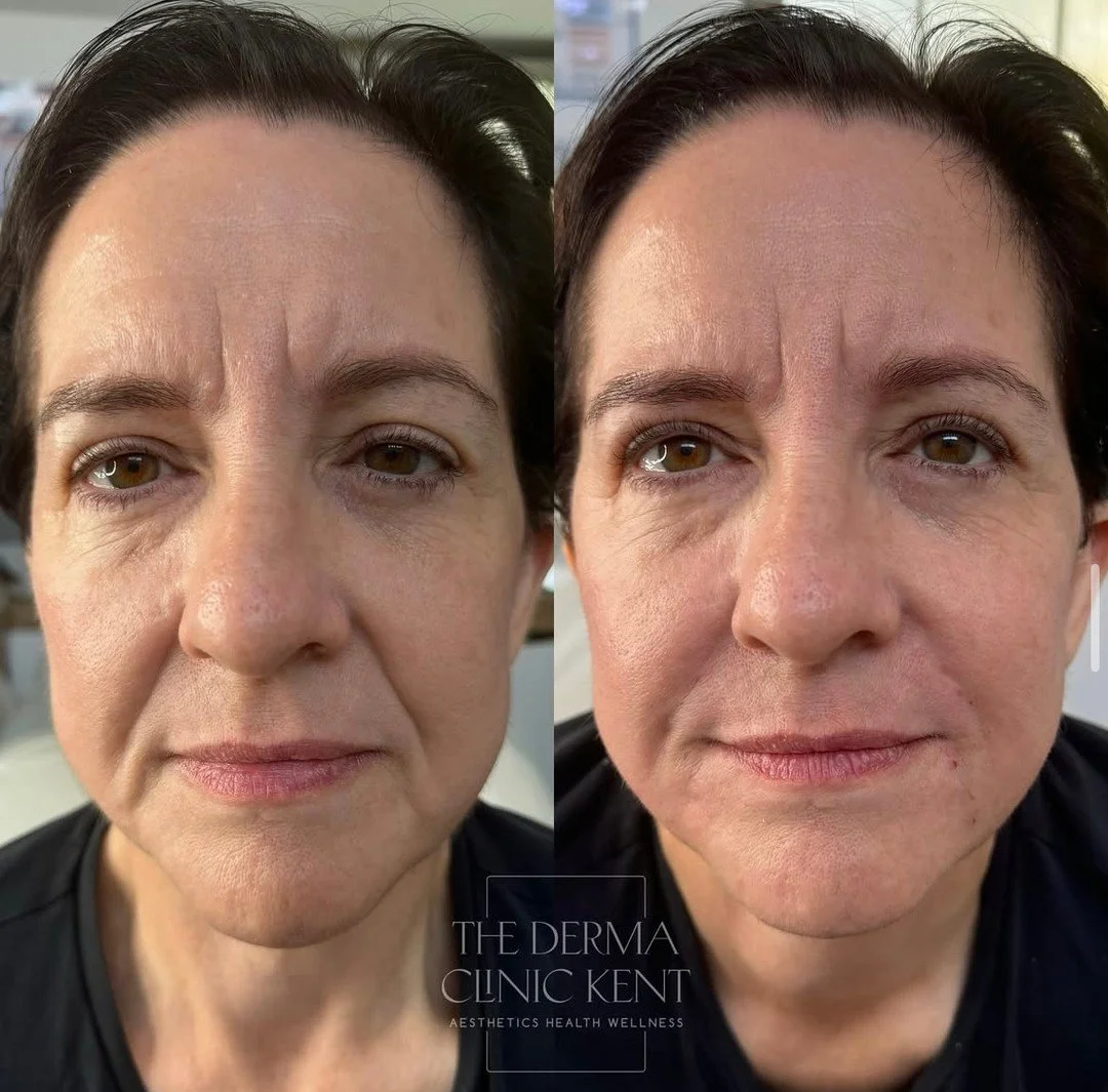 When our patient first came to us, she was feeling a little “meh” about her skin - oily, dull, with a build-up of milia that was knocking her confidence.
Together, we built a plan focused on skin health first: Regular Platinum HydraFacia