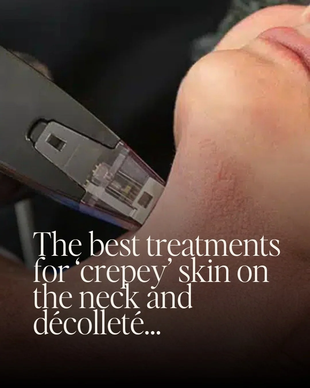 Noticing that the skin on your neck or chest is starting to look thinner, looser or more crepey than it used to?

It&rsquo;s one of the most common concerns we see, especially for women in their 40s and 50s, and it&rsquo;s completely normal.

The ski