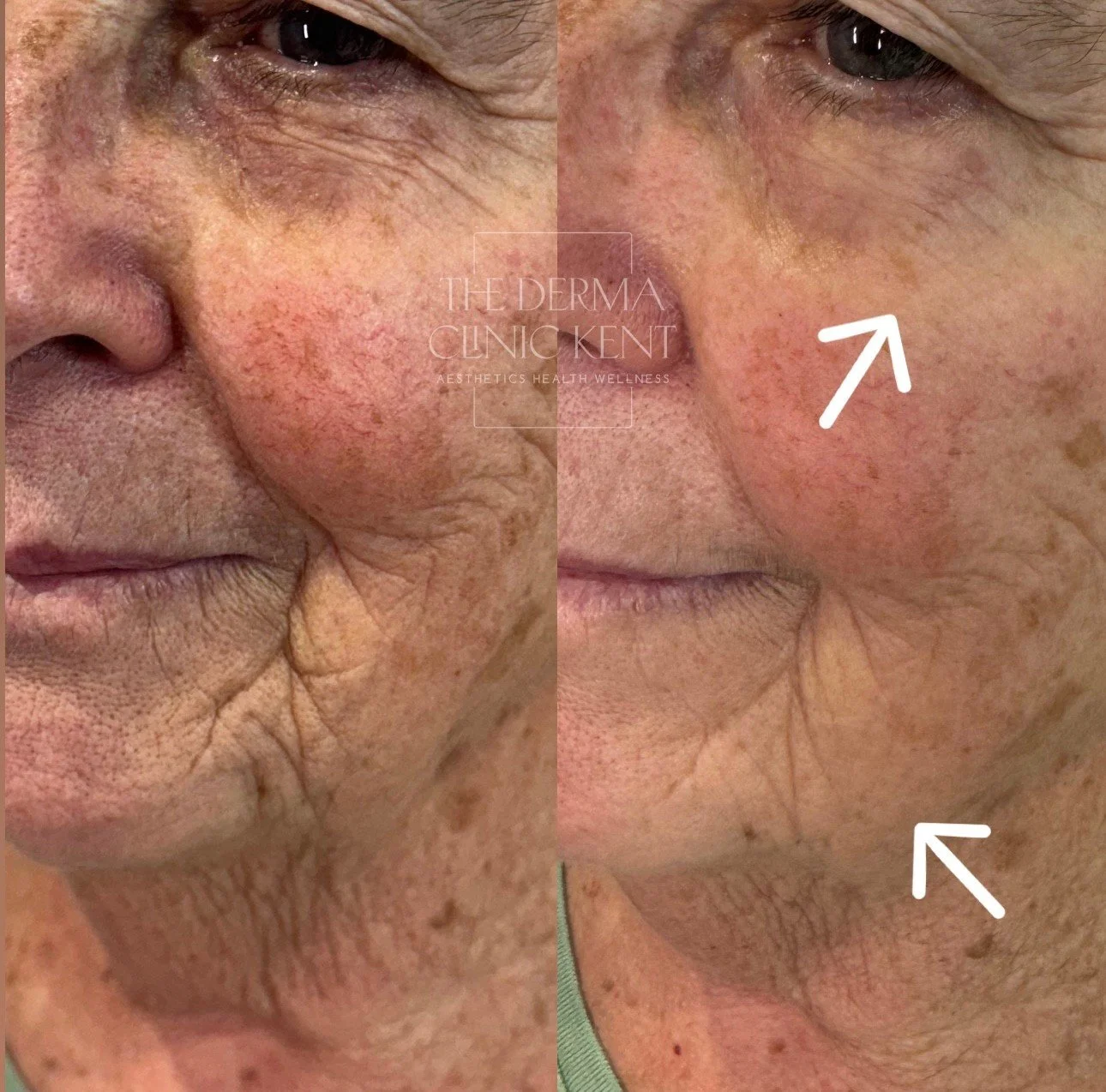 There&rsquo;s something incredibly special about sharing results from the people closest to us, and this one is my lovely mum ✨

She&rsquo;s never had injectables, never wanted anything invasive, and absolutely didn&rsquo;t want downtime, but she did