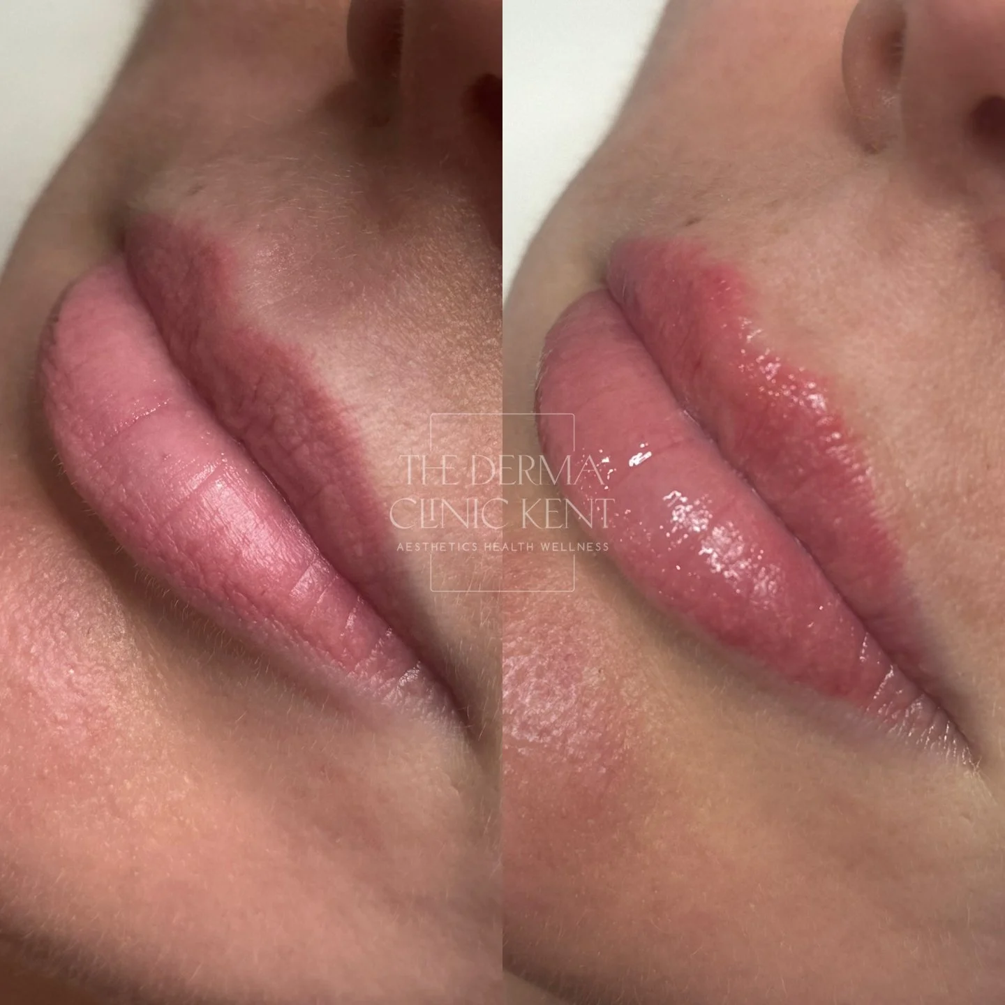 Sometimes the smallest tweak makes the biggest difference 💋

This lovely patient came to me saying what so many women say: &ldquo;I don&rsquo;t want big lips, I just want them to look a bit fresher.&rdquo;

Her lips had started to feel a little drie