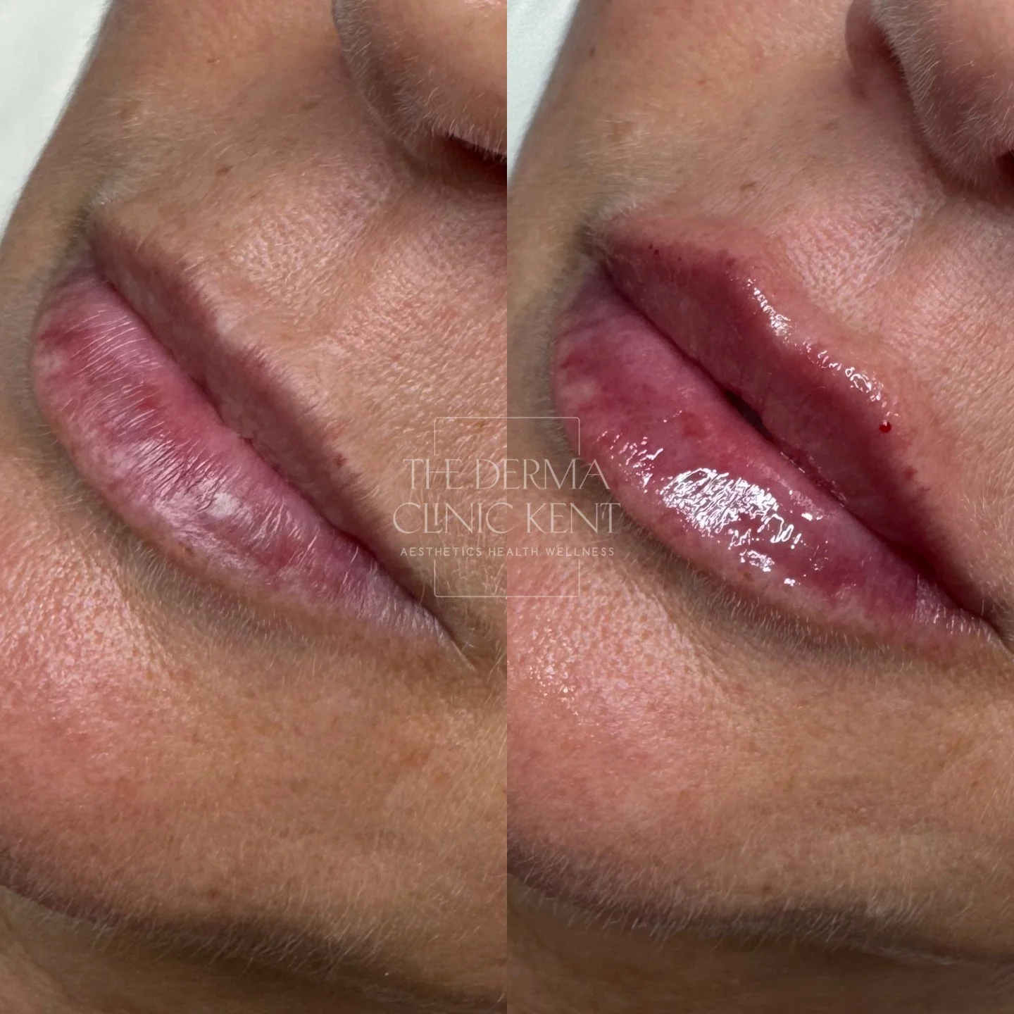 When it comes to lips, subtlety is everything 💋

This lovely patient didn&rsquo;t want bigger lips - she wanted better lips. Softer, smoother, more defined - the kind of natural freshness that makes makeup glide on more easily and brings back that h