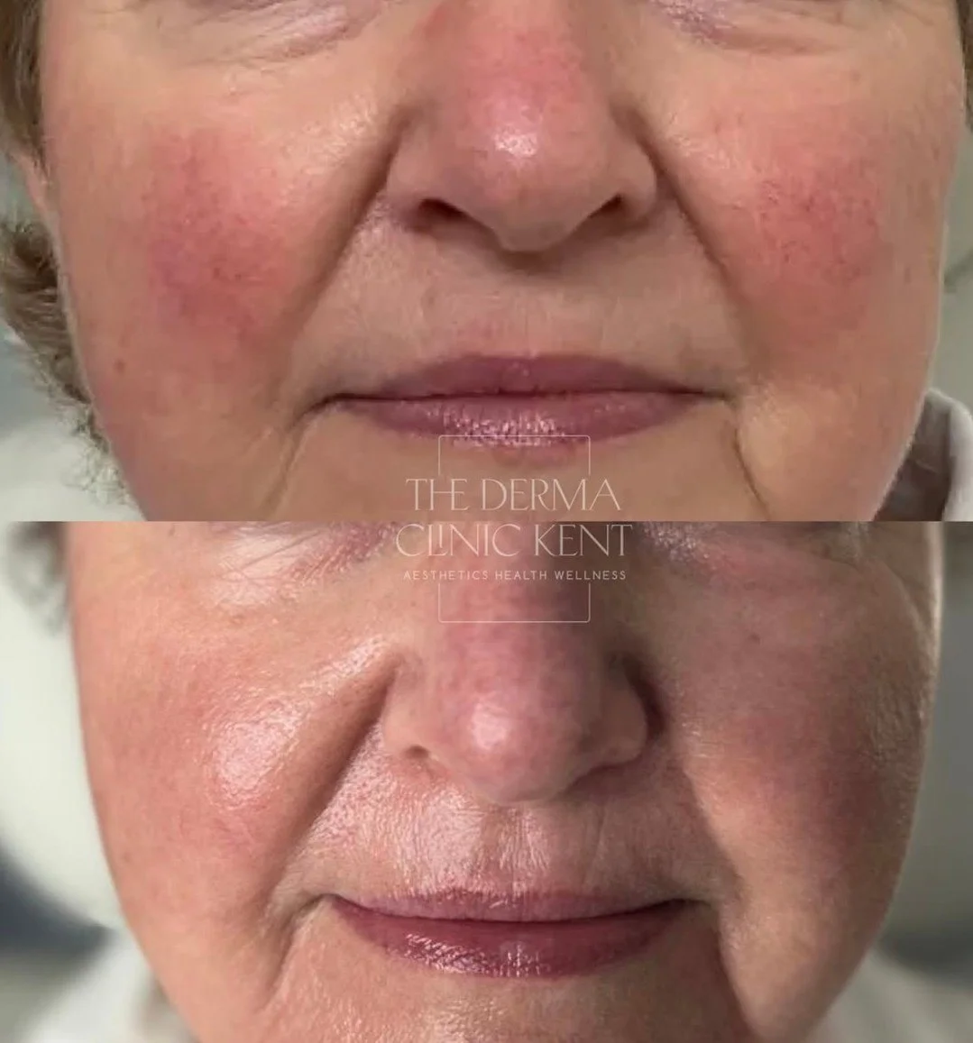 Whether it&rsquo;s flushing, broken capillaries or rosacea-prone skin, redness can be one of the most frustrating concerns to live with. It can make your complexion look uneven and reactive, and it often feels as though no amount of skincare or makeu