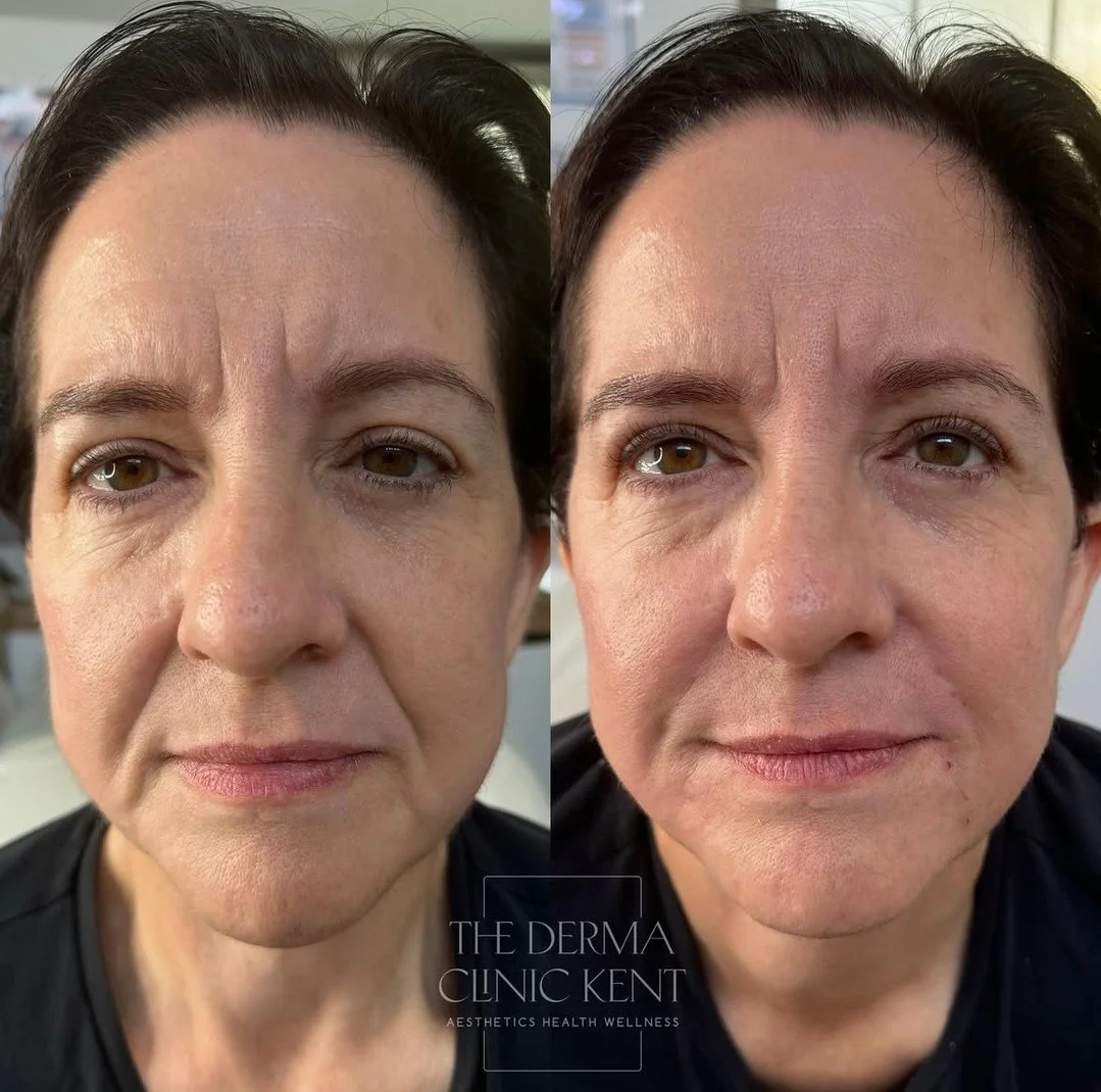 This is one of those skin journeys that truly shows the power of consistency and the right treatments, used at the right time ✨

When this lovely client first came to see me over a year ago, she was struggling with oily, dull skin, congestion and mil