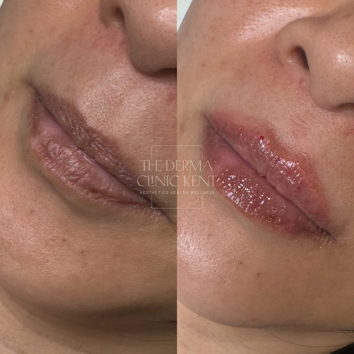 A small amount of filler, when it&rsquo;s placed well, really can make all the difference 💋

This transformation shows what just 0.5ml of Restylane can do when the goal isn&rsquo;t size, but softness, hydration, and balance. Her lips hadn&rsquo;t lo