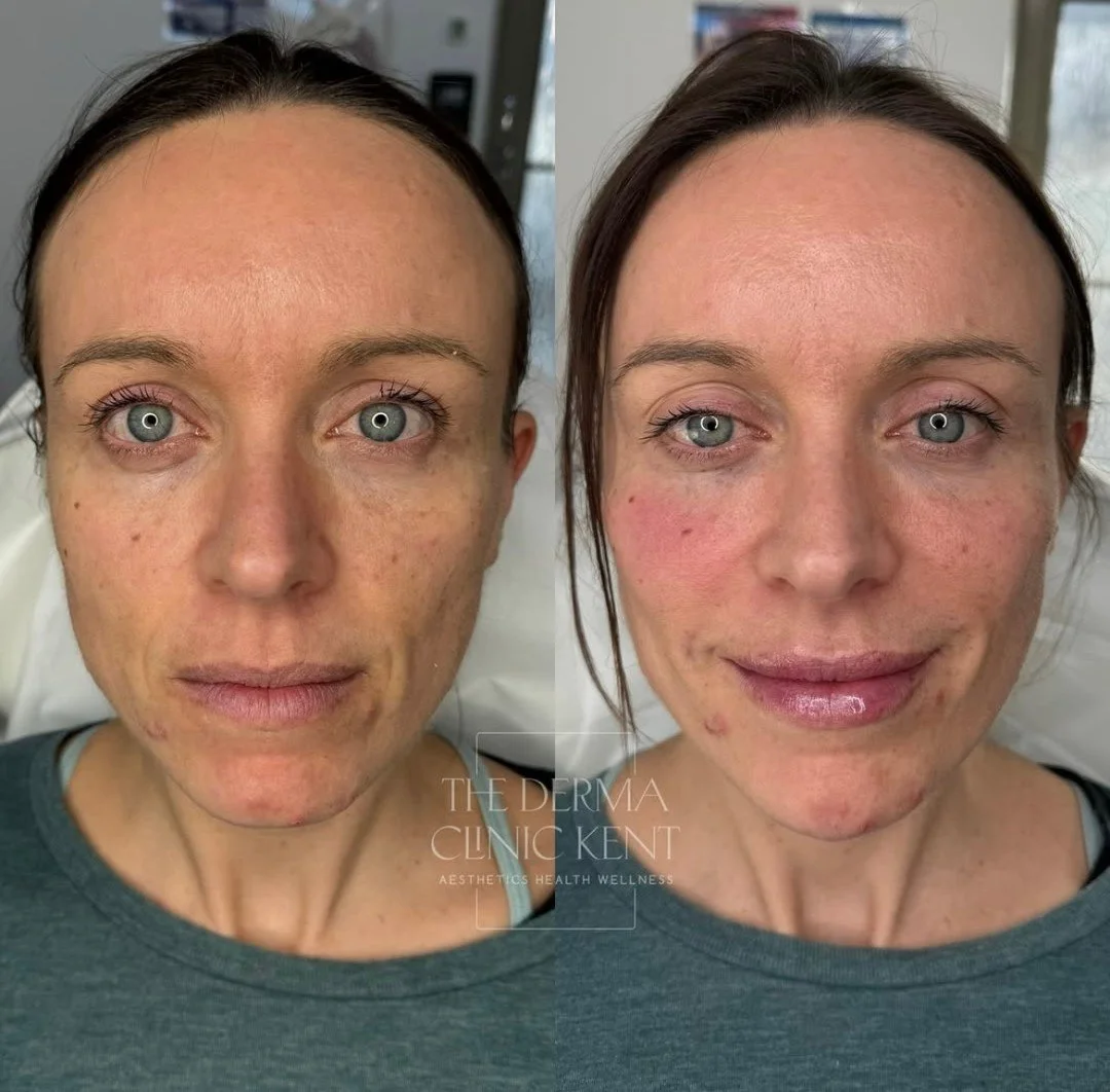 Full face rejuvenation, done properly ✨

True rejuvenation isn&rsquo;t about changing your features or chasing trends, it&rsquo;s about supporting the face as a whole.

Restoring lost structure, improving skin quality and bringing balance back, so yo