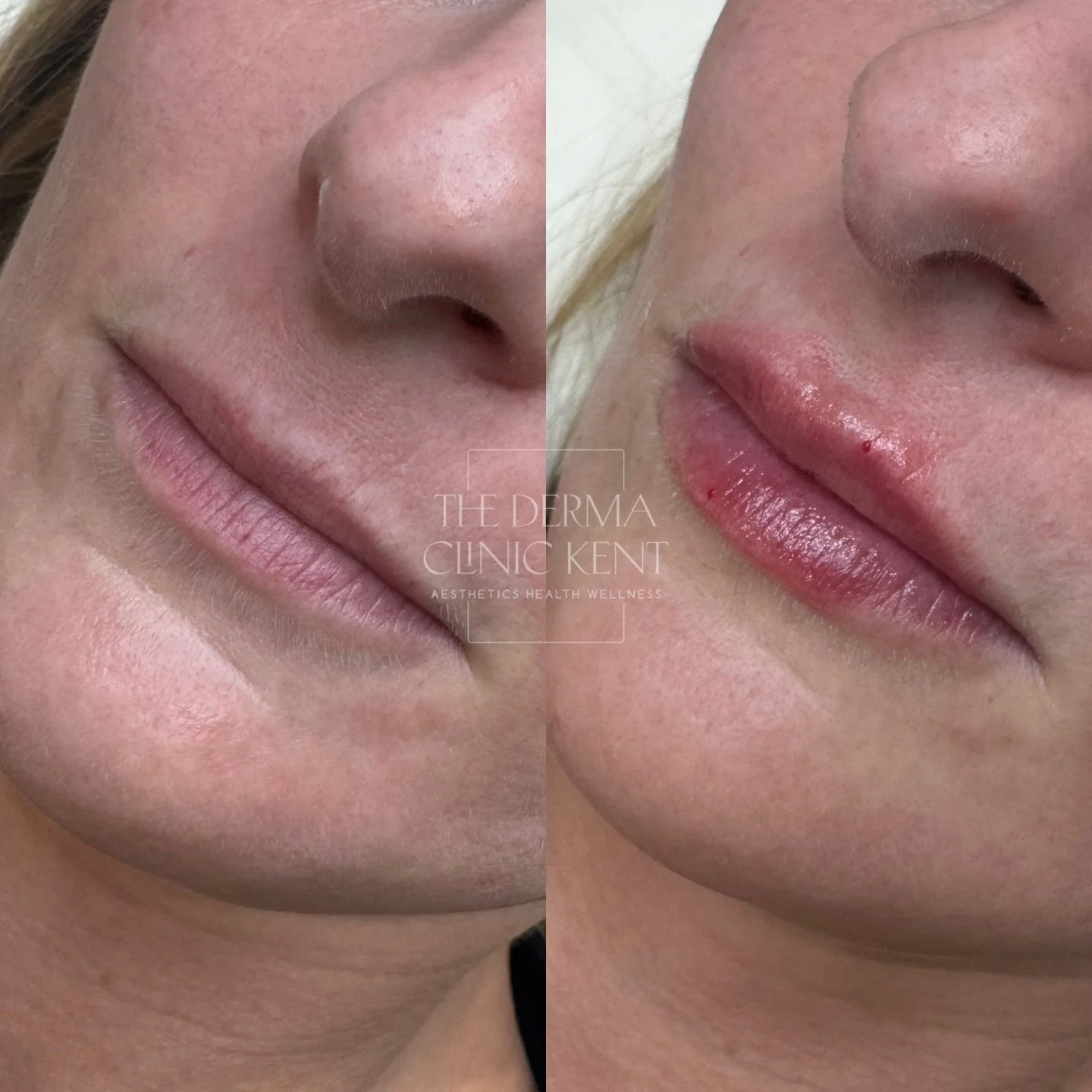 Thin lips don&rsquo;t need to become &ldquo;big&rdquo; to look beautiful, they just need the right kind of support.

Over time, lips can lose hydration, definition and structure, making them appear flatter or less balanced with the rest of the face.
