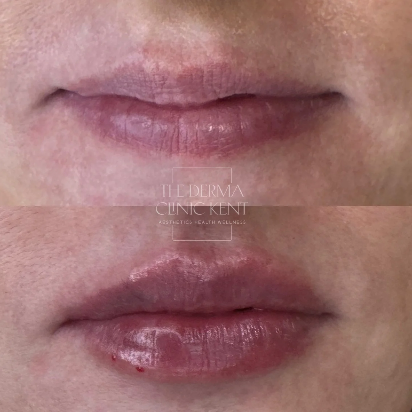This is your reminder that lip enhancement doesn&rsquo;t have to be obvious 💋

The best results aren&rsquo;t about size, they&rsquo;re about softness, balance and lips that still look like your lips.

This shows what a thoughtful, subtle approach ca