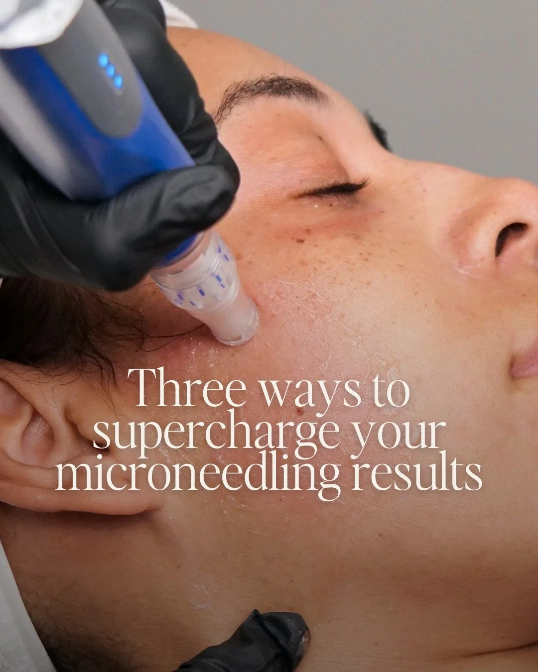 Microneedling is brilliant on its own, but if you&rsquo;ve ever wondered how some people get really good results from it, this is why.

The truth is, it&rsquo;s not just about the treatment itself. What you pair it with, how often you do it, and how 