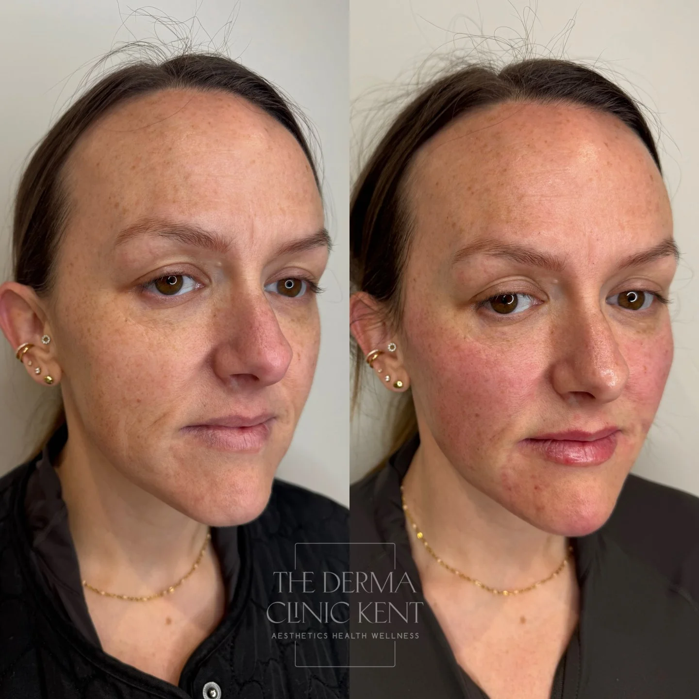 This is what happens when you stop chasing lines and start looking at the whole face ✨

Full face rejuvenation isn&rsquo;t about changing how you look, it&rsquo;s about restoring balance, structure and skin quality in a way that feels natural and tho