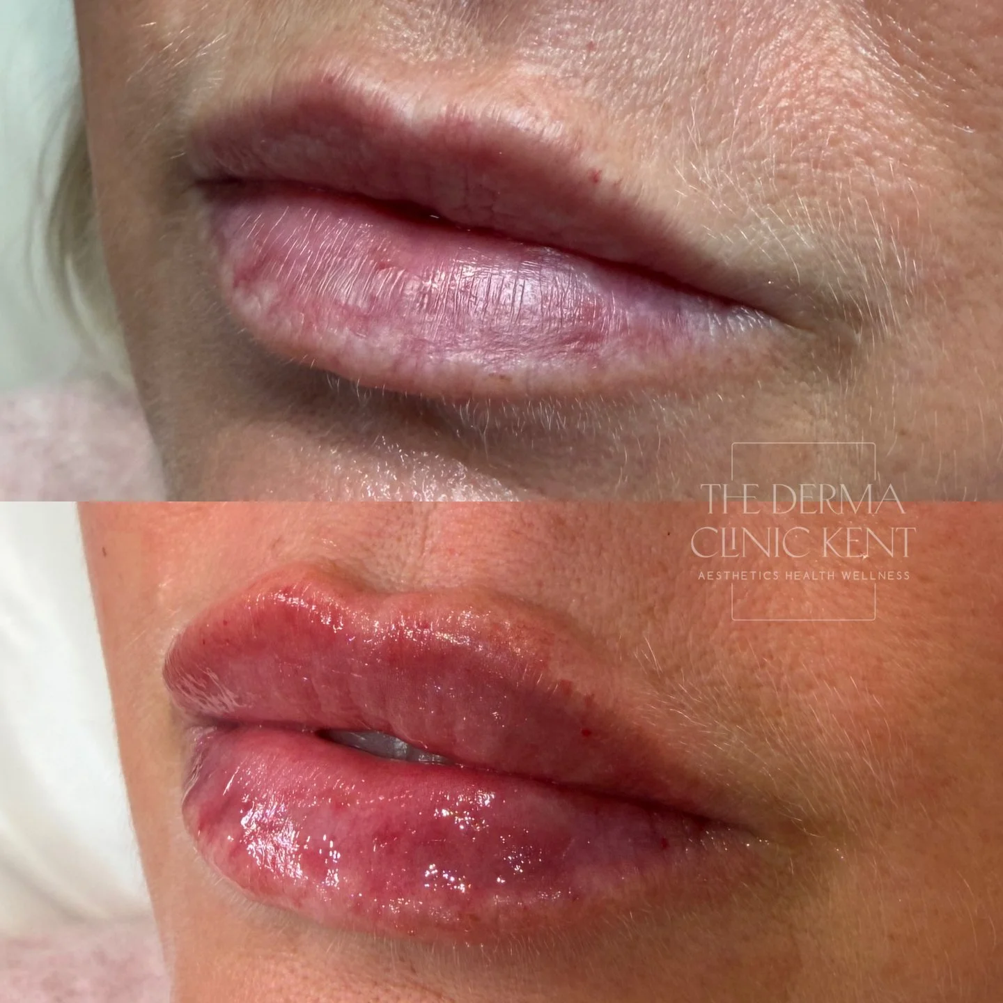 Not all lip appointments are about adding more, sometimes it&rsquo;s about keeping things just right 💋

A 0.5ml top-up is often all that&rsquo;s needed to refresh hydration, softly redefine the borders and maintain that natural shape as filler settl