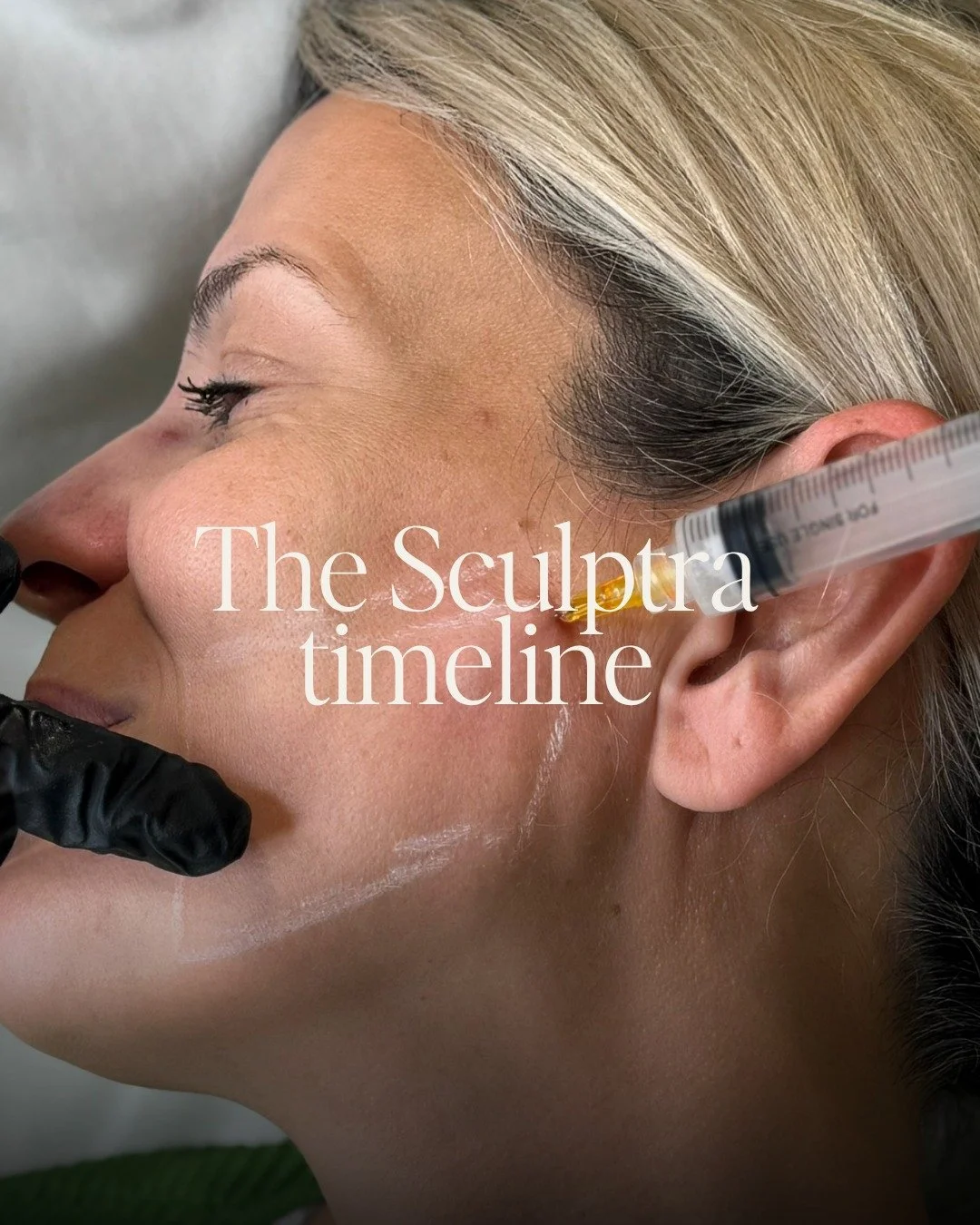We are losing 1% of our collagen every year - this is why you should be considering Sculpta now!

This isn&rsquo;t a treatment that changes your face overnight. It works gradually, rebuilding your own collagen and restoring support in a way that look