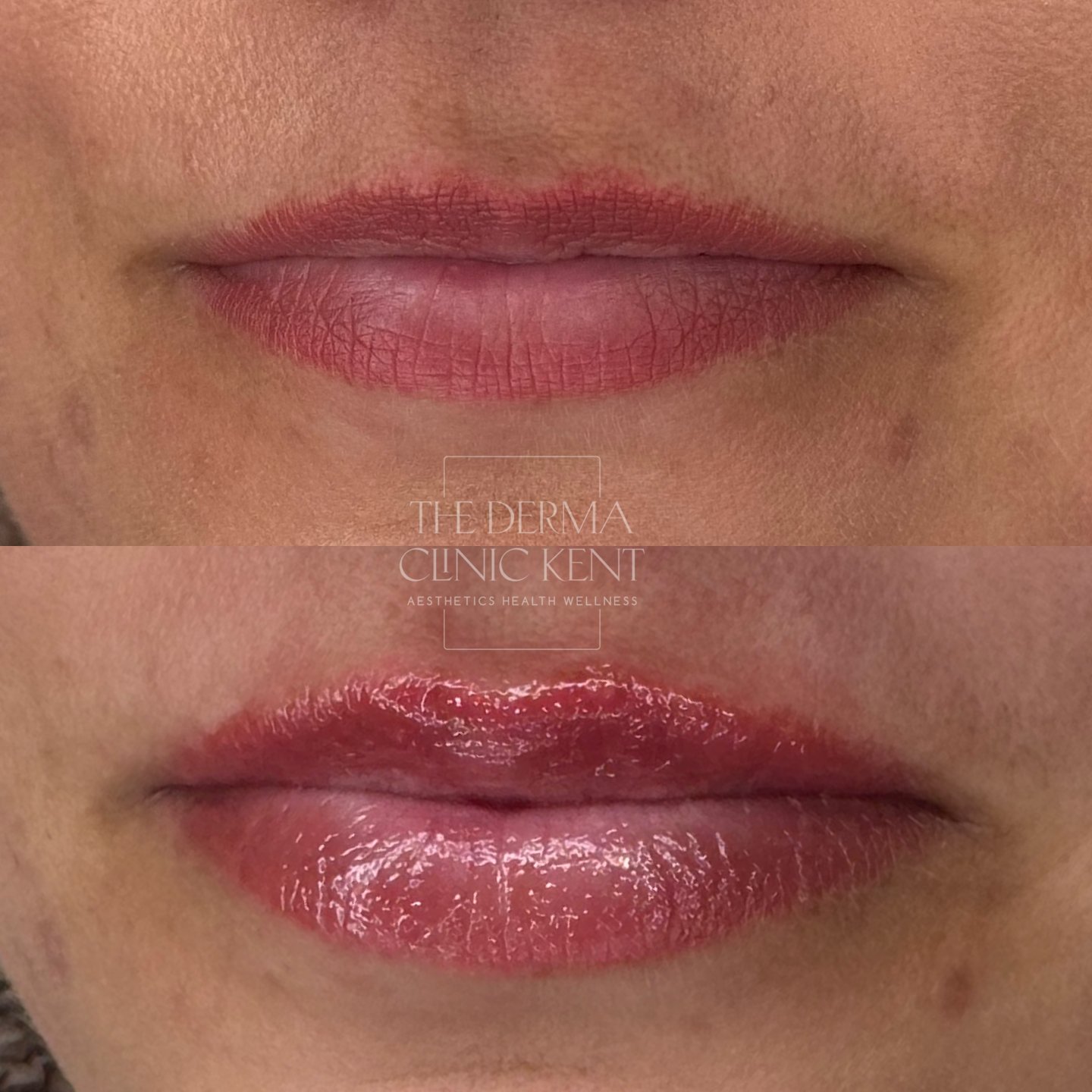 It&rsquo;s all in the details 👄

This transformation shows how lip filler can be done right - subtle, natural, and perfectly in proportion with the rest of your face. No overdone look here, just a careful tweak to hydrate, define, and add volume exa